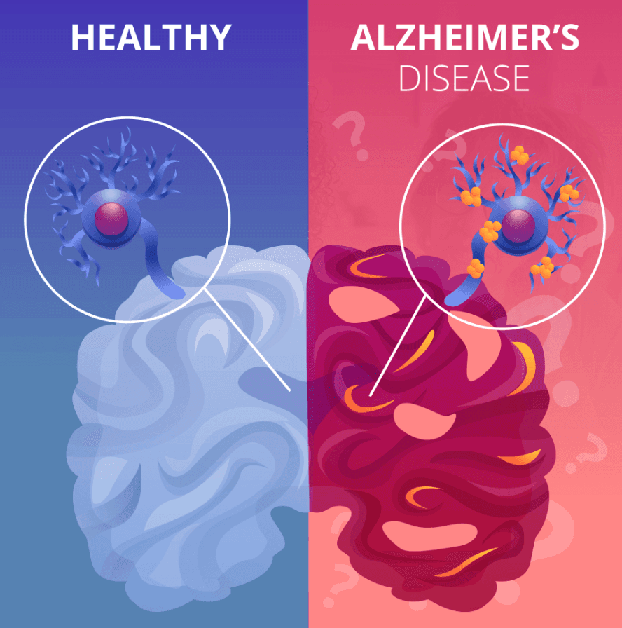 A Comparative Study for Early Diagnosis of Alzheimer's Disease Using Machine Learning Techniques